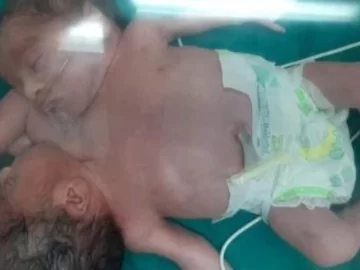 Egipto: nacieron gemelos siameses unidos por el pecho