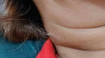 Comió pescado y terminó con una espina saliendo por el cuello: la foto que impactó a todos